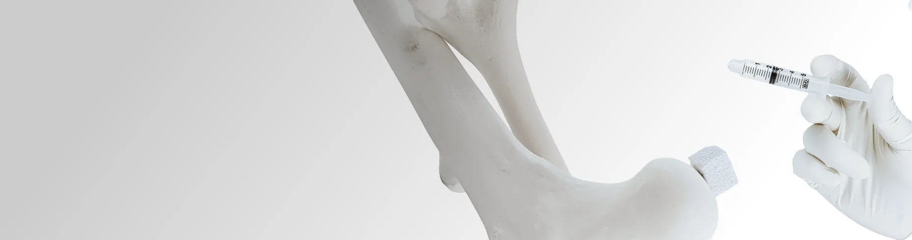 Bone model with a gloved hand holding a syringe of bone substitute